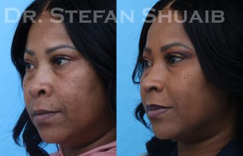 female patient before and after african american rhinoplasty procedure