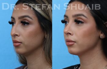 patient before and after rhinoplasty