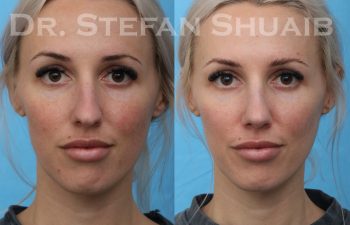 female patient before and after rhinoplasty procedure