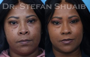 female patient before and after african american rhinoplasty procedure