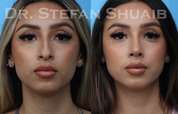 patient before and after rhinoplasty