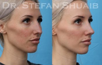 female patient before and after rhinoplasty procedure