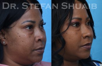 female patient before and after african american rhinoplasty procedure