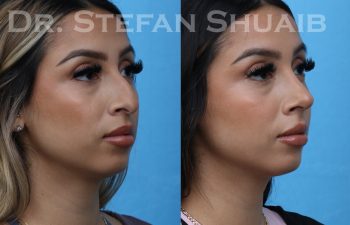 patient before and after rhinoplasty