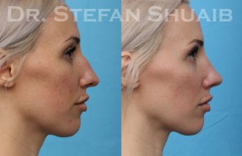 female patient before and after rhinoplasty procedure