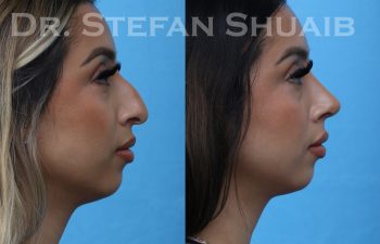 patient before and after rhinoplasty