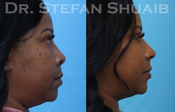 female patient before and after african american rhinoplasty procedure