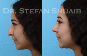 patient before and after rhinoplasty