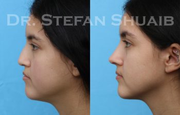 patient before and after rhinoplasty