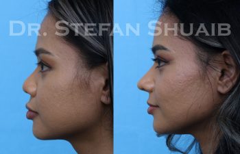 patient before and after asian rhinoplasty