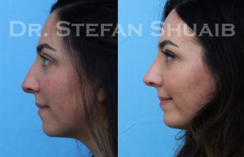 patient before and after rhinoplasty