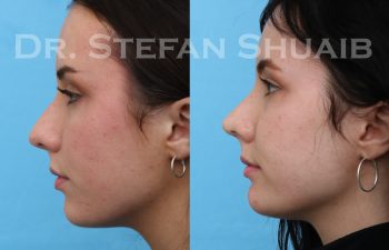 patient before and after rhinoplasty