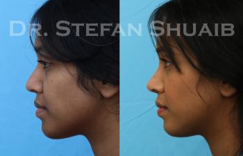 patient before and after rhinoplasty