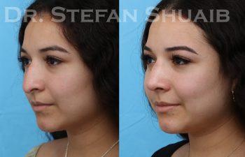 patient before and after rhinoplasty