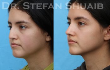 patient before and after rhinoplasty