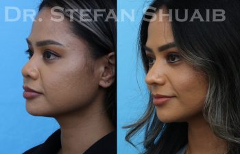 patient before and after asian rhinoplasty