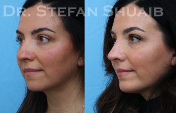 patient before and after rhinoplasty