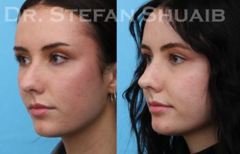 patient before and after rhinoplasty