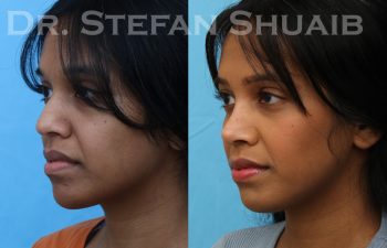 patient before and after rhinoplasty