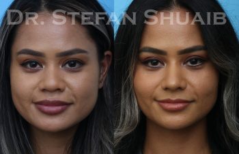 patient before and after asian rhinoplasty