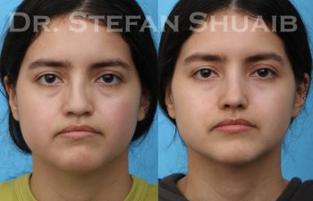 patient before and after rhinoplasty