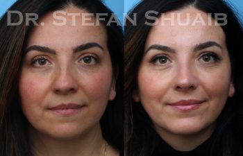 patient before and after rhinoplasty