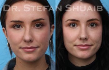 patient before and after rhinoplasty