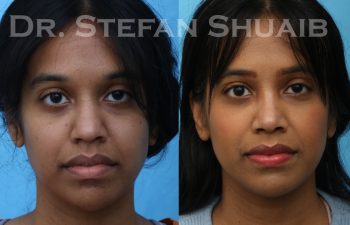 patient before and after rhinoplasty