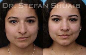 patient before and after rhinoplasty