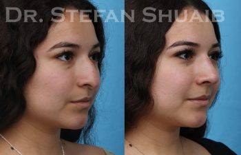 patient before and after rhinoplasty