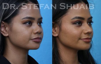 patient before and after asian rhinoplasty