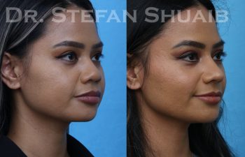 patient before and after asian rhinoplasty