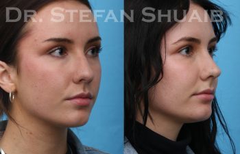 patient before and after rhinoplasty