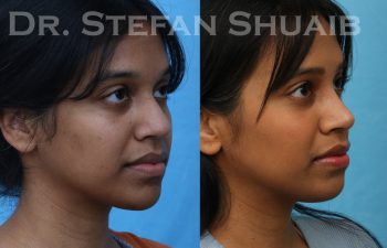 patient before and after rhinoplasty