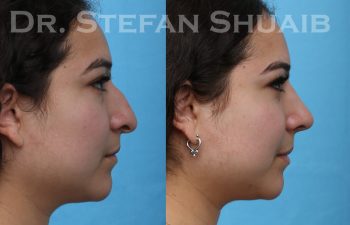 patient before and after rhinoplasty