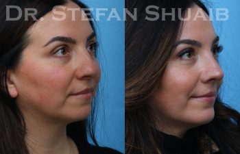 patient before and after rhinoplasty