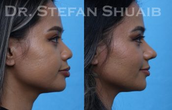 patient before and after asian rhinoplasty