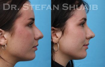 patient before and after rhinoplasty