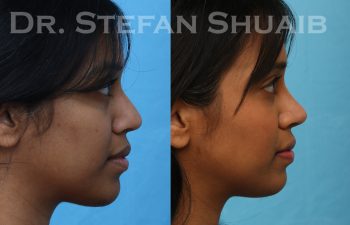 patient before and after rhinoplasty