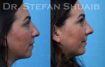 patient before and after rhinoplasty