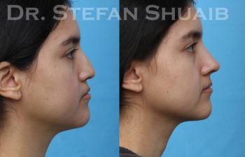 patient before and after rhinoplasty