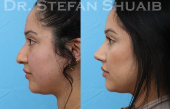 patient before and after rhinoplasty