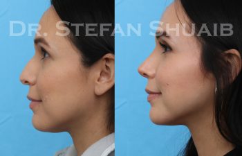 patient before and after rhinoplasty