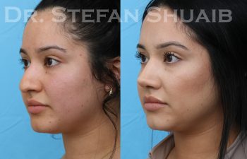 patient before and after rhinoplasty