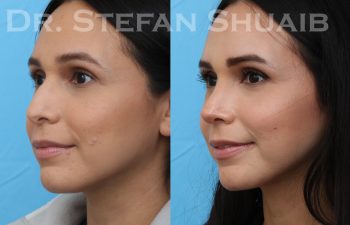 patient before and after rhinoplasty