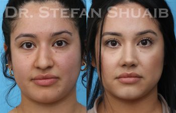 patient before and after rhinoplasty