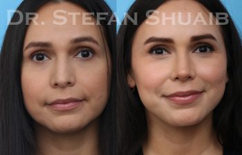 patient before and after rhinoplasty