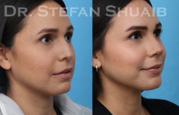 patient before and after rhinoplasty