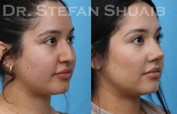 patient before and after rhinoplasty