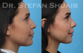 patient before and after rhinoplasty